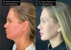 Mentoplastia com Lipo de Papada: A Combinação Ideal para um Contorno Facial Harmonioso