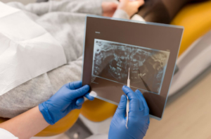 Implante Zigomático em Blumenau: solução segura para casos complexos de implantes dentários